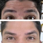 botox